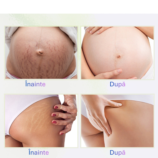 Stretch Mark Repair Cream – Hidratare, Fermitate & Reducerea Cicatricilor