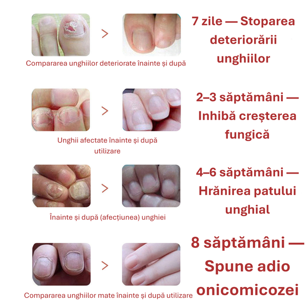 FungiNail – Tratament Rapid împotriva Ciupercii Piciorului